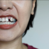 Phục hình răng đã mất khi bị tiêu xương hàm cần lưu ý gì?