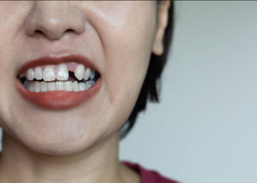 Phục hình răng đã mất khi bị tiêu xương hàm cần lưu ý gì?