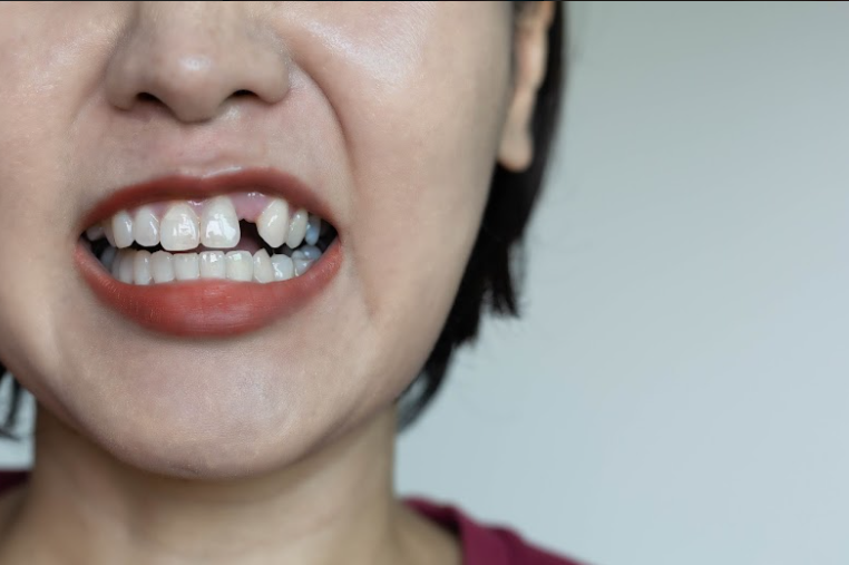 Vùng xương hàm ở khoảng trống mất răng không phải chịu tác động của lực nhai trong thời gian dài sẽ dần bị tiêu biến.