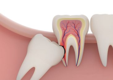 Răng khôn là một trong những vấn đề muôn thuở khiến nhiều người quan tâm