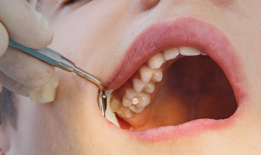 Nhổ răng không làm ảnh hưởng đến sức khỏe nếu được thực hiện đúng kỹ thuật