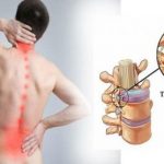 10 Bài tập thể dục hiệu quả cho người thoát vị đĩa đệm