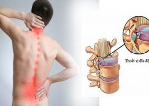 10 Bài tập thể dục hiệu quả cho người thoát vị đĩa đệm