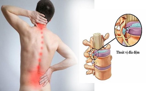 bi-thoat-vi-dia-dem-do-dau Bị thoát vị đĩa đệm là do đâu?