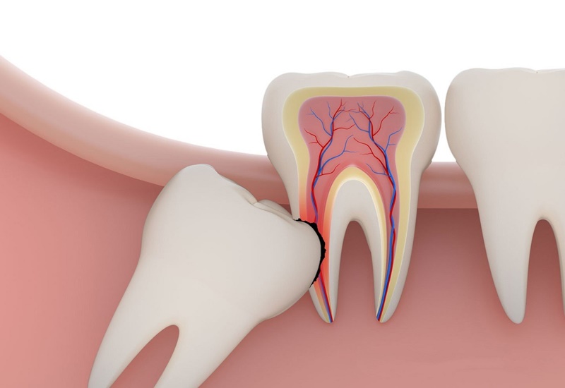 httpscaodangquany1-edu_-vn-1 Răng khôn là một trong những vấn đề muôn thuở khiến nhiều người quan tâm