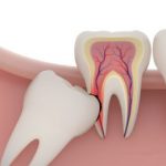Răng khôn bị đau có nên nhổ không và những câu hỏi thường gặp