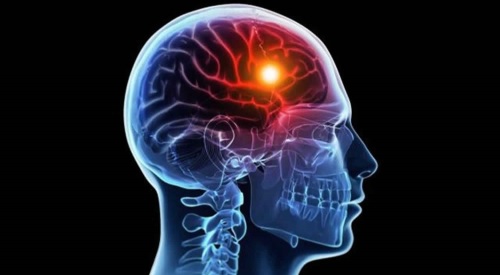 thieu-oxy-len-nao Thiếu oxy lên não là gì?